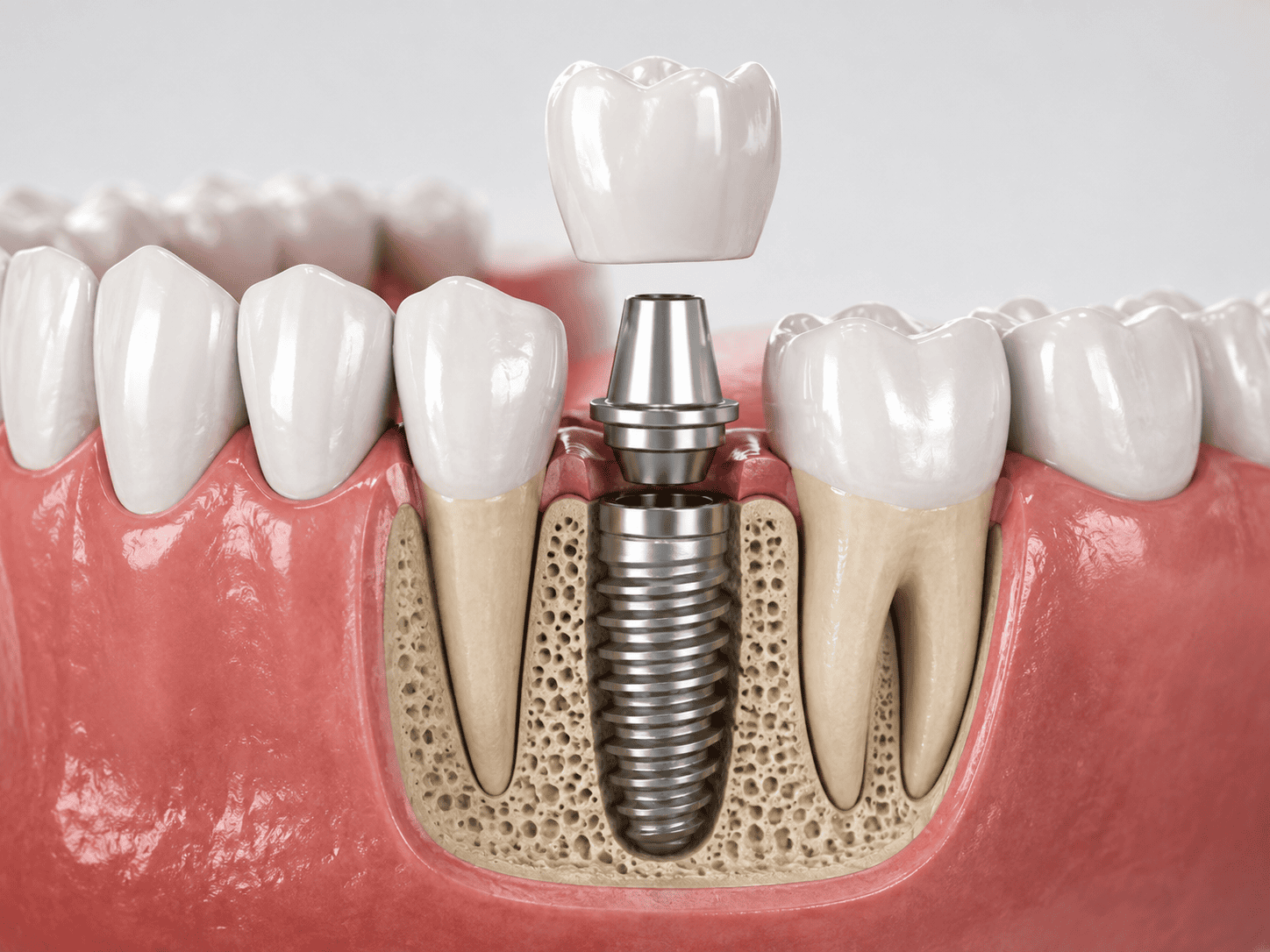 Cross-sectional view of a dental implant in the jawbone with an abutment and crown being placed atop the implant.